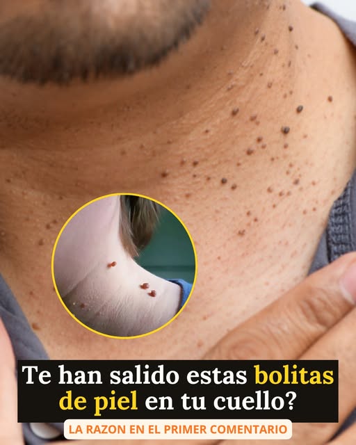 ¿Qué son estas bolitas que salen en el cuello y por qué aparecen?