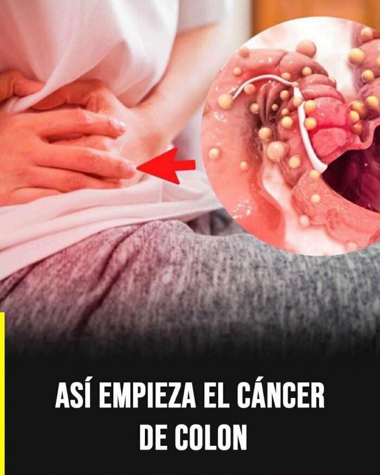 Cáncer de colon: las señales tempranas que muchas personas confunden con problemas digestivos comunes