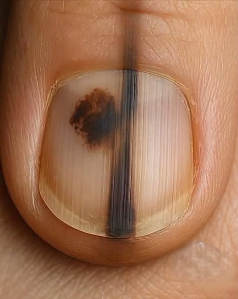 Mancha oscura en la uña: cuándo puede ser una señal de melanoma y no un simple golpe