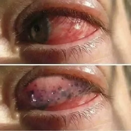 Las consecuencias para los ojos al dormir de forma incorrecta o incómoda