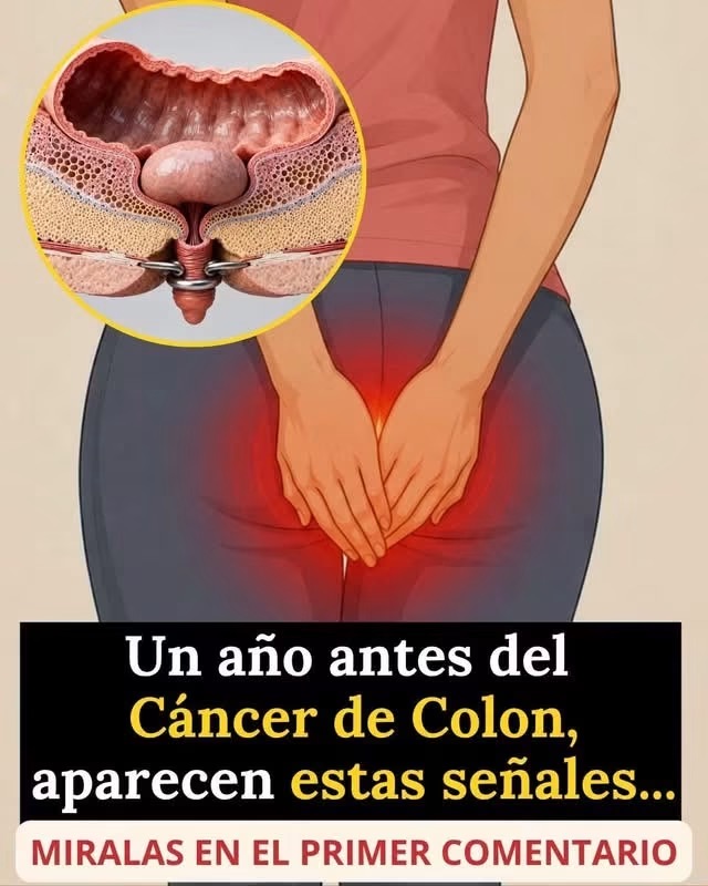 🚨 Así comienza el cáncer de colon: las señales silenciosas que casi nadie nota