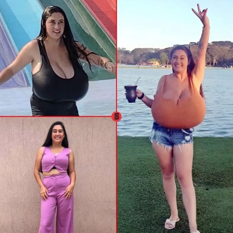 Joven brasileña supera rara condición de gigantomastia tras cirugía de más de 10 horas
