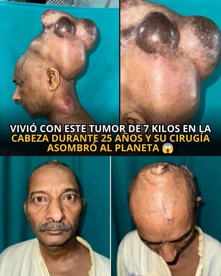 Vivió durante 25 años con un enorme tumor en la cabeza: la compleja cirugía