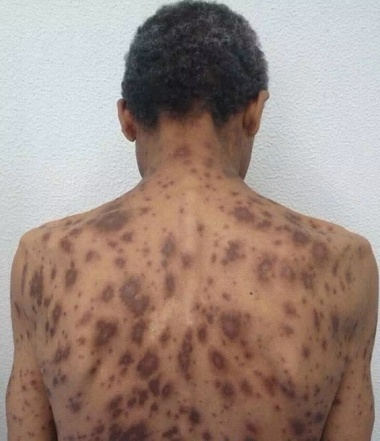 Por qué aparecen manchas oscuras en la piel? Estas son las causas más frecuentes, según la dermatología