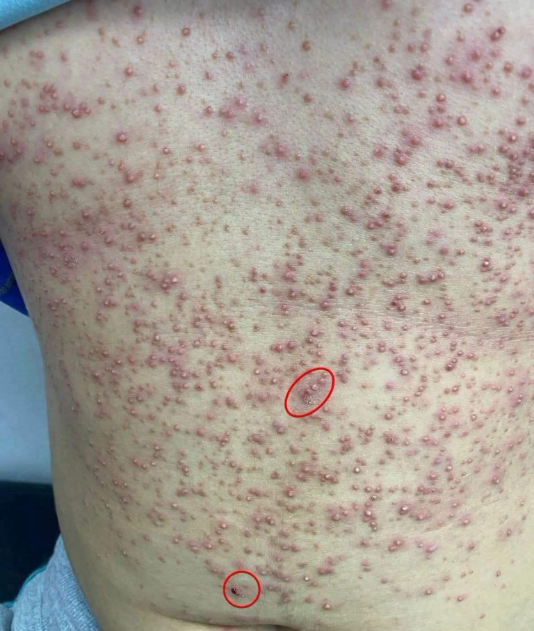 Tienes pequeñas lesiones o ampollas en la espalda? Estas son las causas más frecuentes y cuándo debes consultar al médico