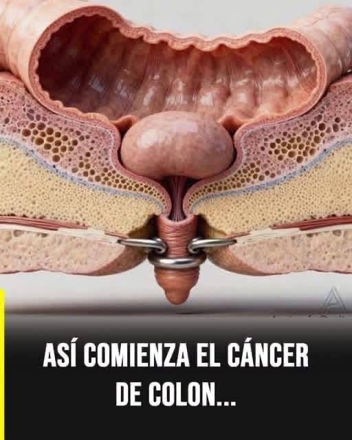Así comienza el cáncer de colon? Lo que realmente puede confirmarse sobre la imagen viral
