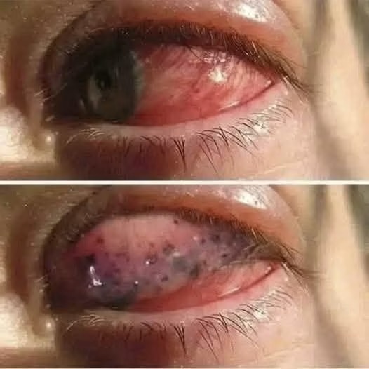 Consecuencias reales de dormir con lentes de contacto y las señales que no debes ignorar