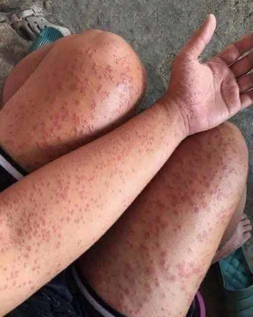 Consecuencias de dormir sin cambiar las sábanas durante mucho tiempo: esto podría ocurrir en tu piel