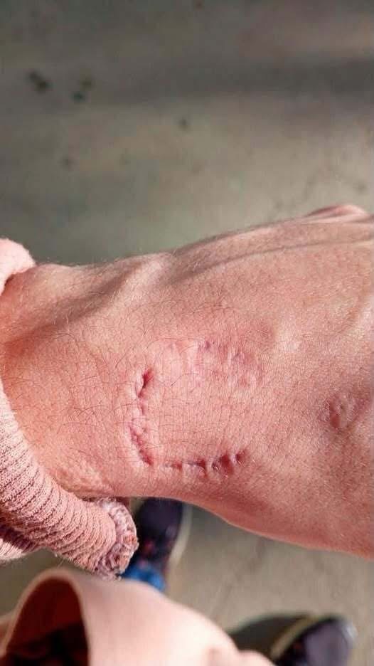 Una denuncia escolar por una lesión en el brazo genera preocupación entre las familias